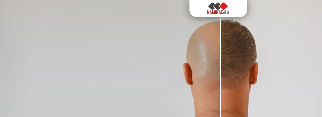 کاشت مو ابرو اقساطی
